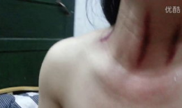 揪脖子痧视频,轻松缓解颈部酸痛的神奇疗法